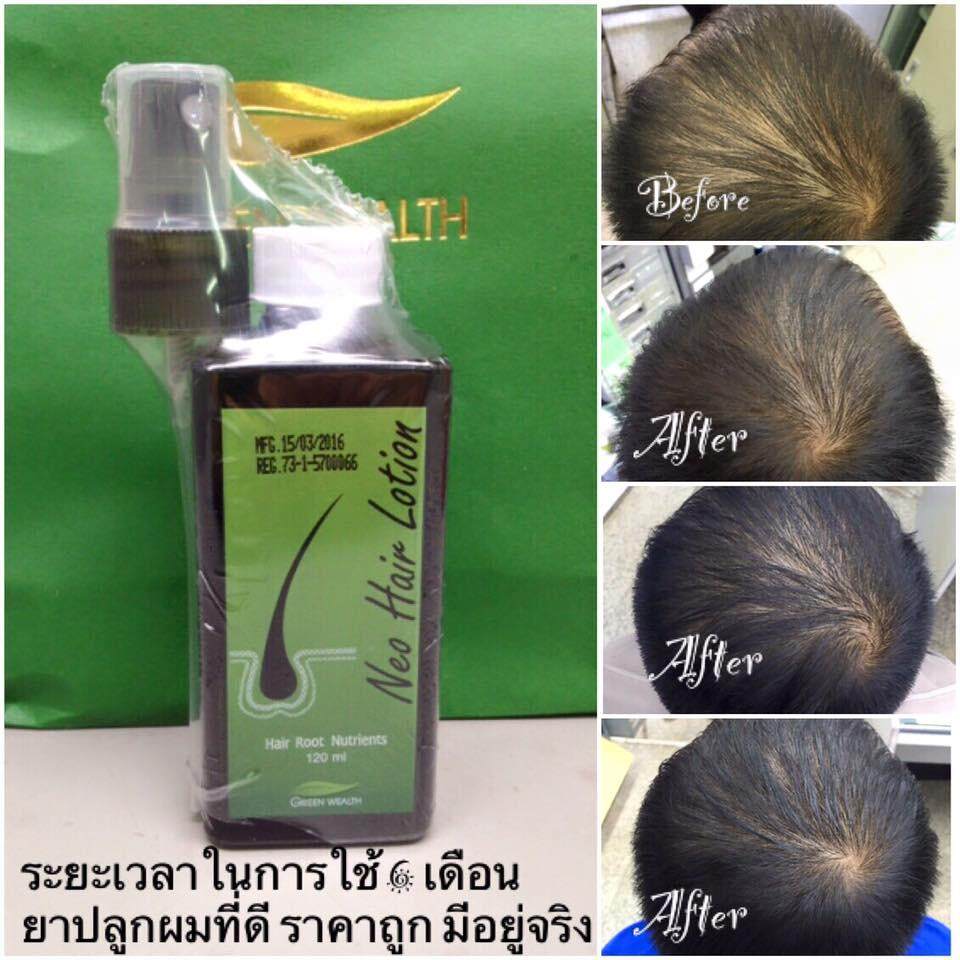 [ Bigsale ] Neo Hair Lotion Hair Growth Solution Original Thaiproduct Murah