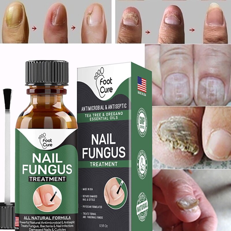 30ml Nail Repair Liquid Fungal Liquid Anti Fungus Toenail Fingernail Nails Care Liquid