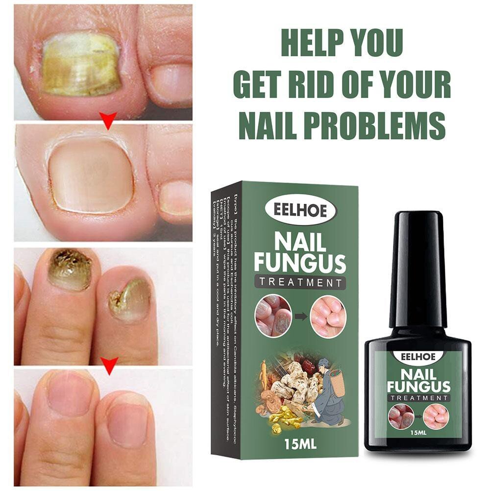 15ml Nail Fungal Liquid Anti Fungus Toenail Fingernail Nails Care Liquid Best Buy