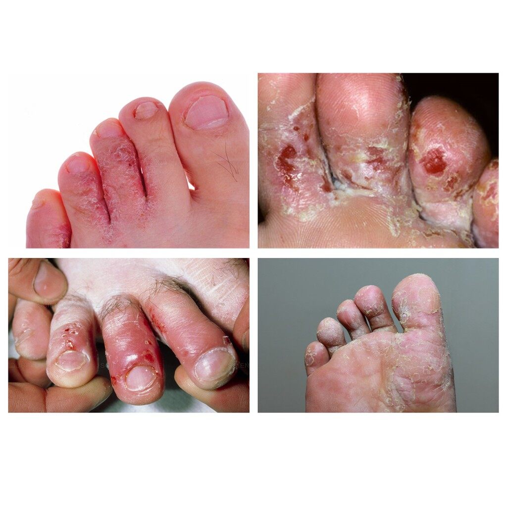 BIG Foot Cures Athlete's Foot Care (100ml) Anti Fungal Antibacterial Spray Treatment Itch Deodorant Berbau Kaki Gatal
