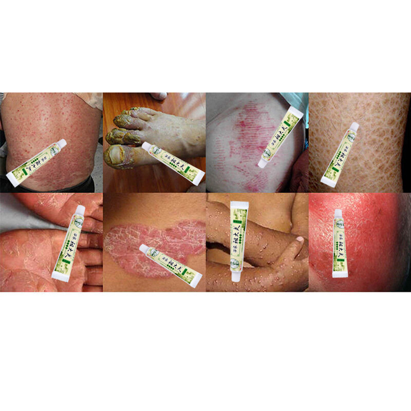 Psoriasis Eczema Ointment Dermatitis Vitiligo Skin Rash Cream
