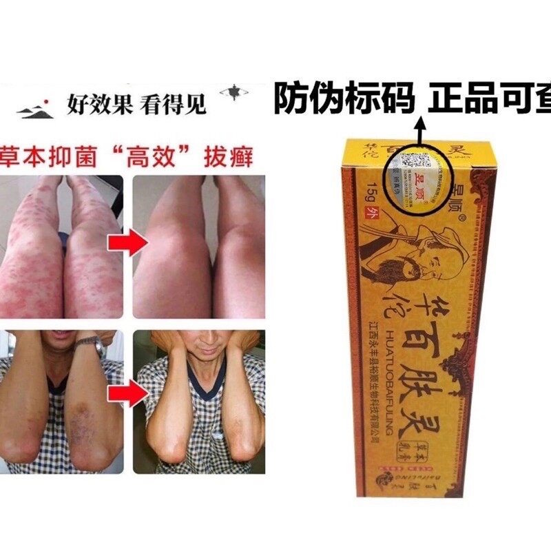 Natural Chinese Herbal Medicine Cream Eczema Psoriasis Antibacterial Antifungal 华佗百肤灵