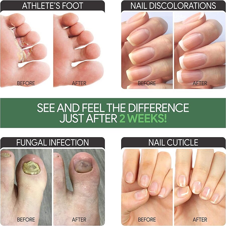 30ml Nail Repair Liquid Fungal Liquid Anti Fungus Toenail Fingernail Nails Care Liquid