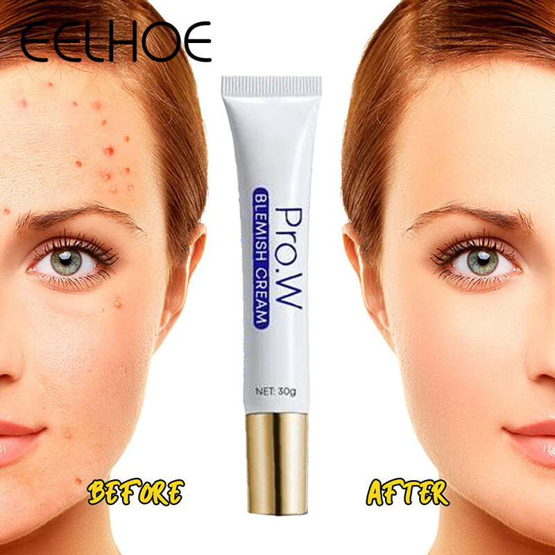 Eelhoe kem trị mụn kem mặt ngừa mụn loại bỏ mụn kiểm soát dầu thu nhỏ lỗ chân lông 20g