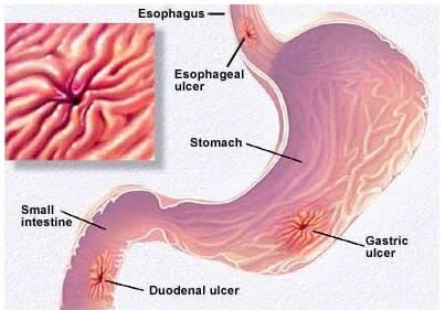 gastric_stomach_ulcer