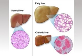 Liver_Problems_Normal_Fatty_Cirrhotic_liver