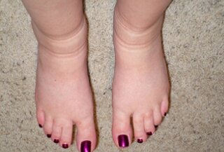 swollen-foot-and-ankle